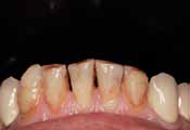 Детальный вид нижних передних зубов до лечения