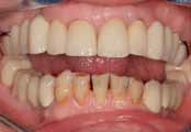 Прямая реставрация передних нижних зубов с использованием компониров