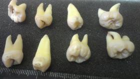 Удаленные зубы у одного пациента