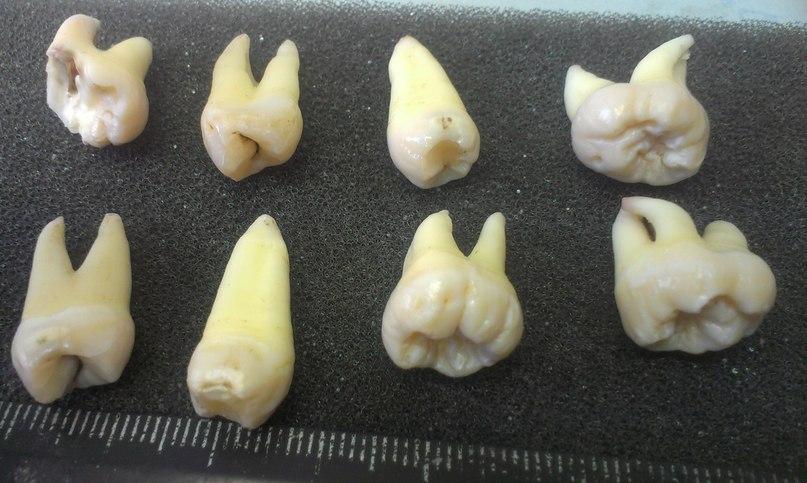 Удаленные зубы у одного пациента