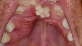 Цветочные зубы (зубы Гетчинсона) 2