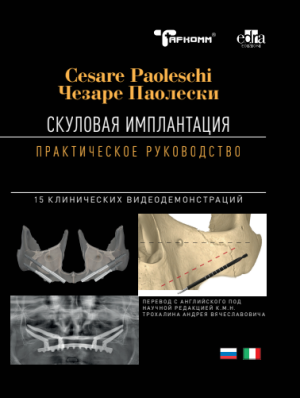 Чезаре Паолески - Скуловая имплантация. Практическое руководство. - Книги по имплантологии (фото 1)
