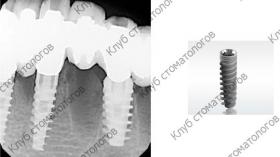 ADIN Dental Implants Touareg S