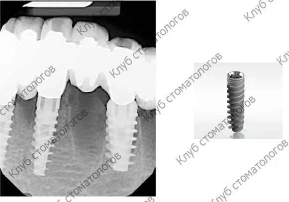 ADIN Dental Implants Touareg S