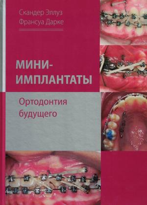 Эллуз С., Дарке Ф. - Мини-имплантаты. Ортодонтия будущего. - Книги по ортодонтии (фото 1)