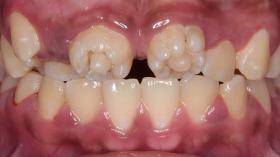 Цветочные зубы (зубы Гетчинсона)