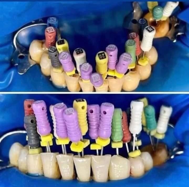 Когда хобби стоматолога - иглоукалывание