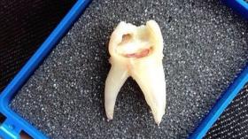 Улыбчивый зуб