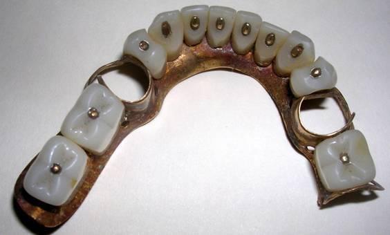 Частично съемный зубной протез 1860г., построенный из металла и вулканита