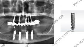 ADIN Dental Implants Touareg NP