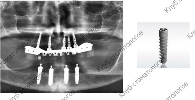 ADIN Dental Implants Touareg NP