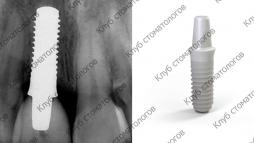 Straumann PURE Ceramic Implant Monotype