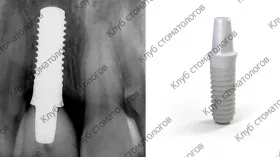 Straumann PURE Ceramic Implant Monotype