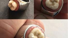 Кольцо для стоматолога 19