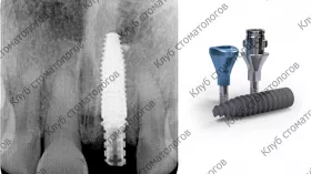 Straumann Bone Level Tapered