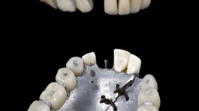 Частично съемный зубной протез на верхнюю и нижнюю челюсть (1858-1880гг.)