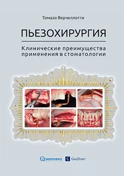 Т. Варчеллотти - Пьезохирургия. Клинические преимущества применения в стоматологии. - Книги по хирургической стоматологии (фото 1)
