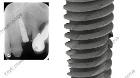 Osstem TS III CA