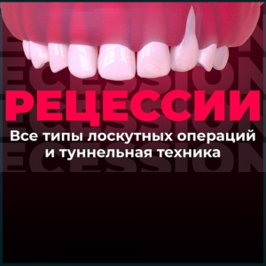 Видеозапись. Джулио Расперини - Мягкотканный менеджмент в регенерации тканей пародонта: работа с межзубным прикреплением при лечении рецессий 3 типа - Книги по пародонтологии (фото 1)