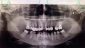 Пациент не мог понять где какой зуб