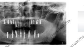 ADIN Dental Implants Touareg WP