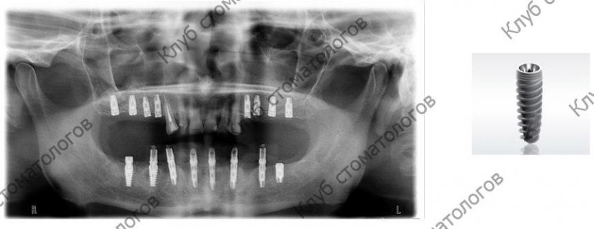 ADIN Dental Implants Touareg WP