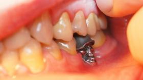 Зубная коронка - череп 2