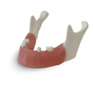 GF Dental E82 Модель нижней челюсти для практики установки имплантатов - Модели для практики (муляжи, тренажеры) (фото 1)