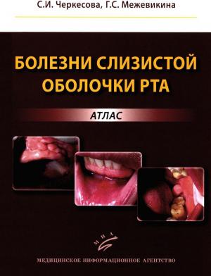 Черкесова С.И., Межевикина Г.С. - Болезни слизистой оболочки рта: атлас - Книги по общей стоматологии (фото 1)