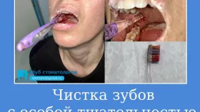 Чистка зубов с особой тщательностью
