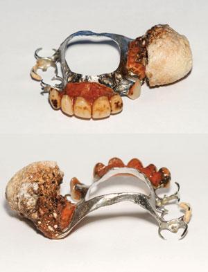 Зубной протез с зубным камнем