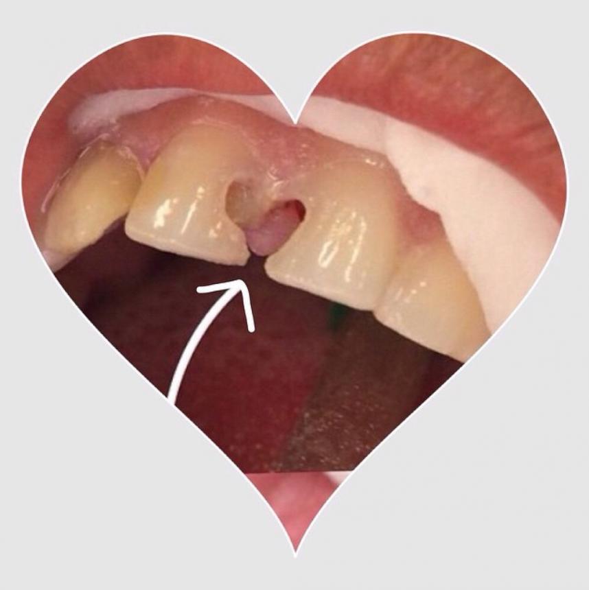 Зубная любовь 1