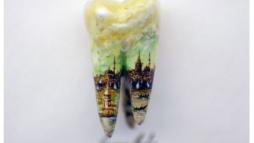 Микроарт на зубе