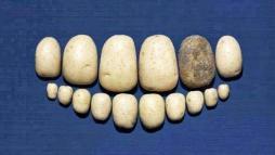 Зубной камень 2