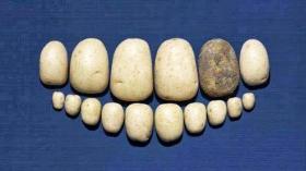 Зубной камень 2
