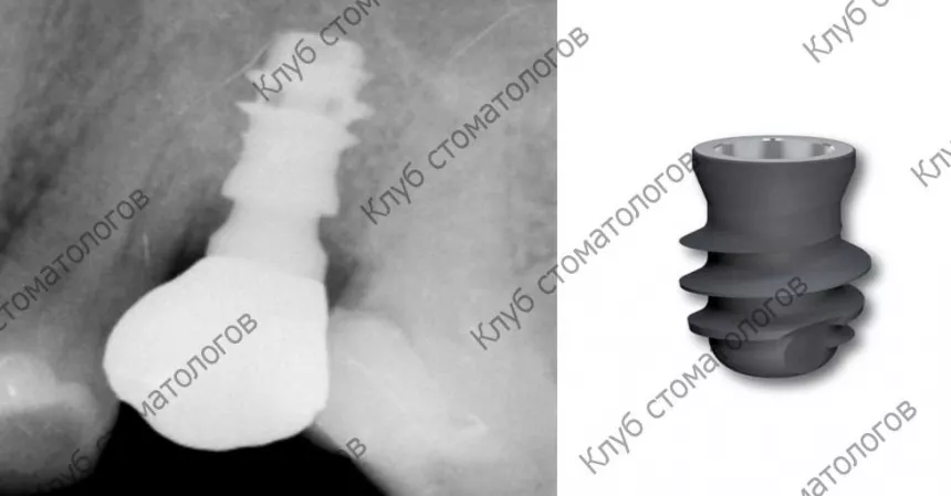 Leone Exacone Short Implant