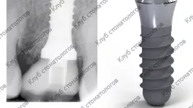 Straumann Standard