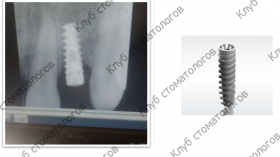 ADIN Dental Implants Touareg RP