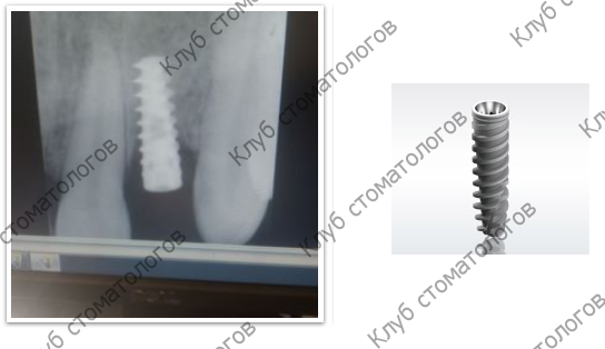 ADIN Dental Implants Touareg RP