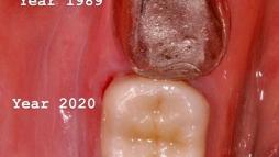 Эволюция зубной коронки