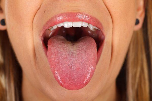 По составу микрофлоры на поверхности языка научились диагностировать сердечную недостаточность