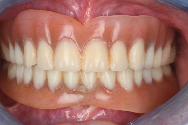 Цифровая реконструкция полости рта: от диагностики до окончательной тотальной реставрации диоксидом циркония