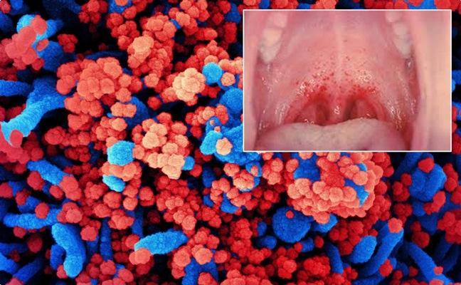 Сыпь во рту может указывать на наличие коронавируса у пациента