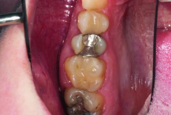 Микроинвазивный подход к лечению с учетом особенностей биомеханики зубов