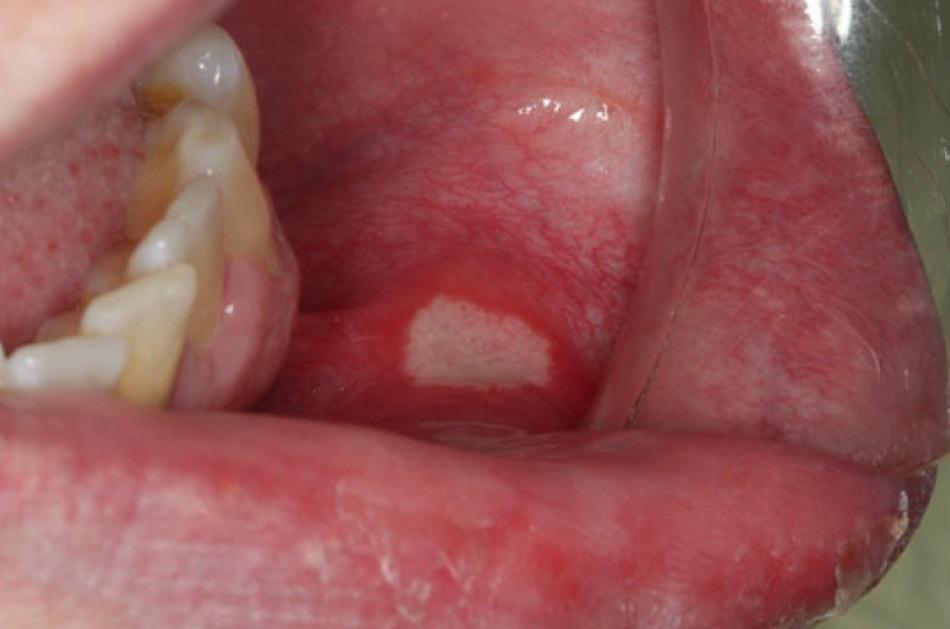 Волосатая лейкоплакия полости рта или языка – симптомы и лечение