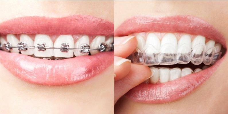 Результаты обзора исследований, сравнивающих методики выравнивания зубного ряда с помощью элайнеров и брекет-систем