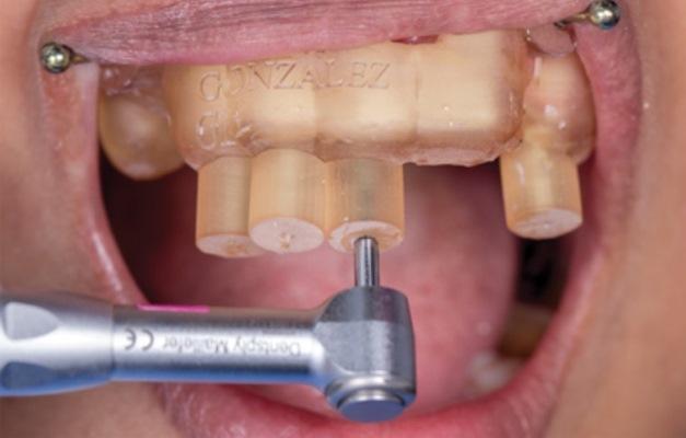 Динамическая навигация: будущее мини-инвазивной стоматологии