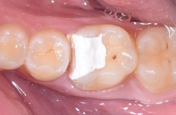 Восстановление жевательного зуба и реколл через 8 месяцев