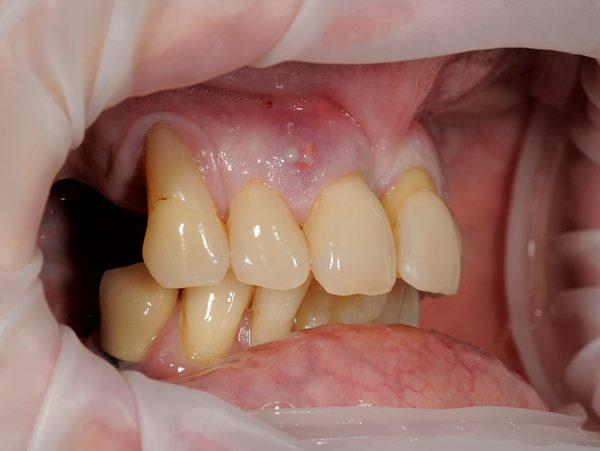 Немедленная имплантация в эстетическую зону 11, 21 и 22 зубов