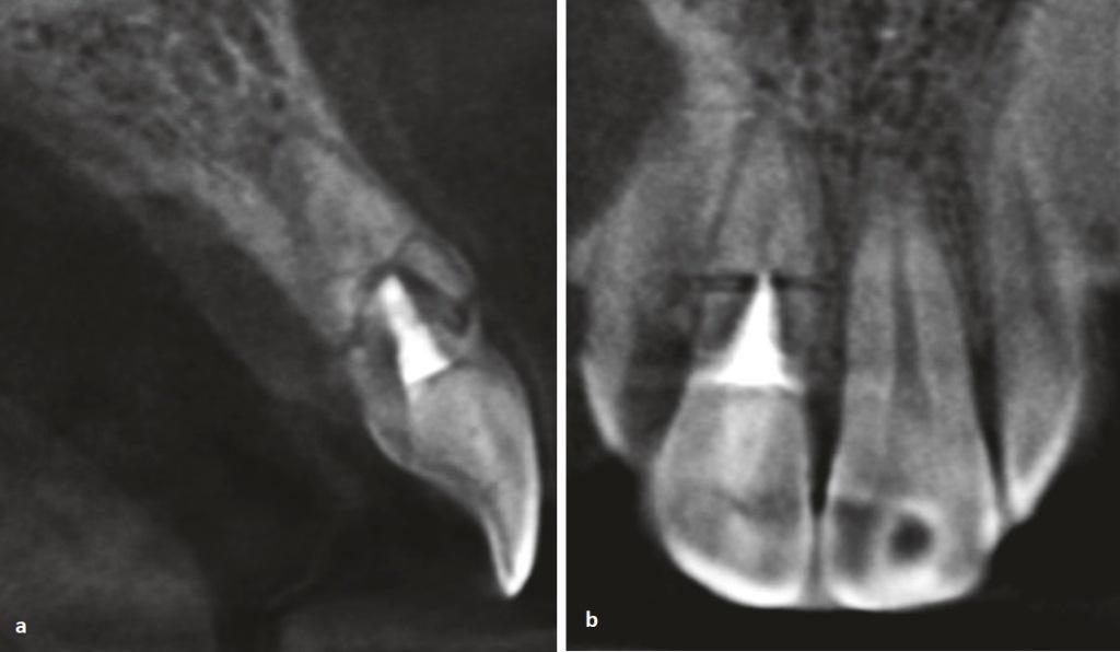 Рентгеновские снимки зубов перелом корня thumbnail